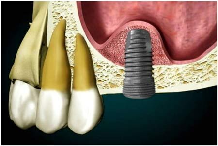 همه چیز در مورد سینوس لیفت در ایمپلنت دندان شامل هزینه و مراحل و مراقبت ها